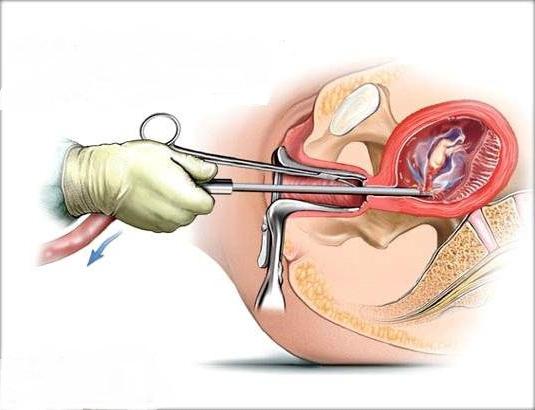 un aborto quirúrgico los clientes
