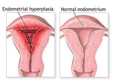 scraping by hyperplasia of the endometrium