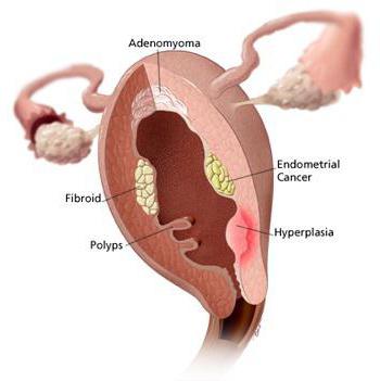 la hiperplasia del endometrio después de raspar