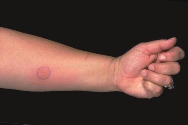 维拉吉的结核菌素皮肤试验的儿童被发射