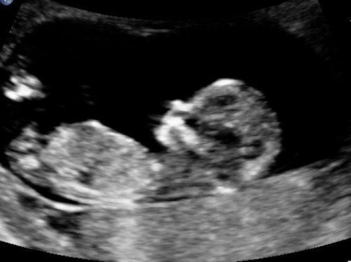 Fotoğraf fetal 9 hafta