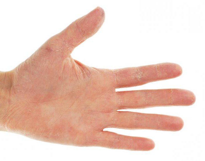 redness and itching on hands