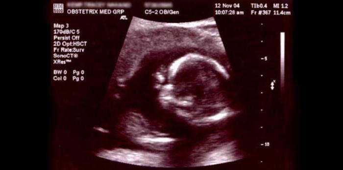 screening of trimester 1 standards for ultrasound