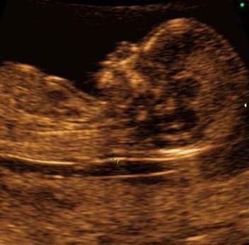 screening standards 1 trimester transcript by ultrasound