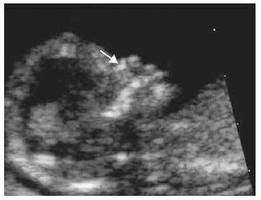 screening of trimester 1 standards for ultrasound nasal bone