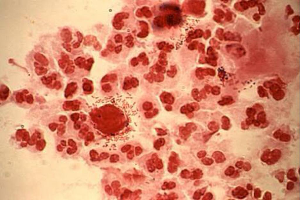 योनि म्यूकोसा trichomoniasis