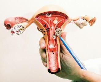 la eliminación de nodos de los fibromas de útero