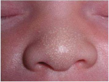 білі крапки на носі у новонародженого