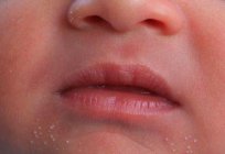 Білі точки на носі у новонародженого. Чому у новонародженого білі крапки на носі? Коли проходять білі крапки на носі у новонародженого?