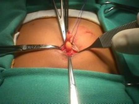  hernia umbilical en adultos después de la operación de la foto