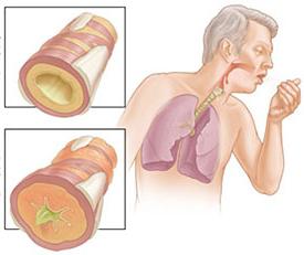 Chronisch obstruktive Lungenerkrankung COPD