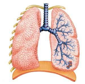 la enfermedad pulmonar Obstructiva