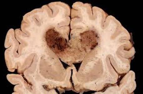 tedavi Edilebilir mi beyin kanseri