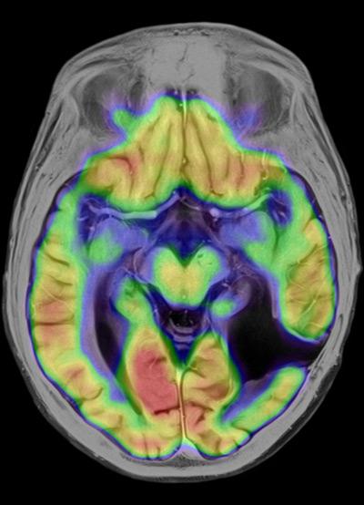 cómo se ve el cáncer de cerebro