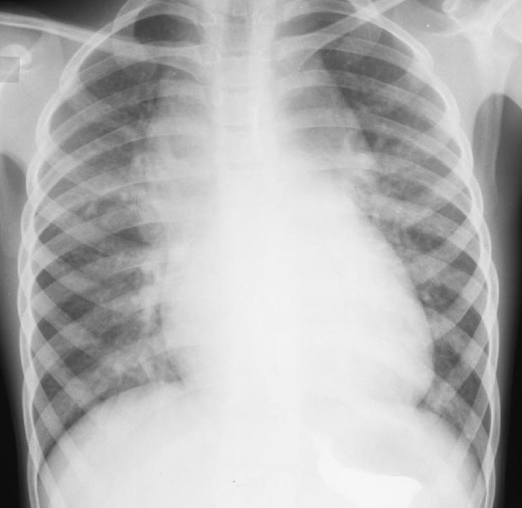 x-ray و الرئة-القلب