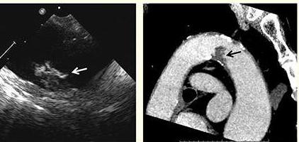 transesophageal echocardiography what is it