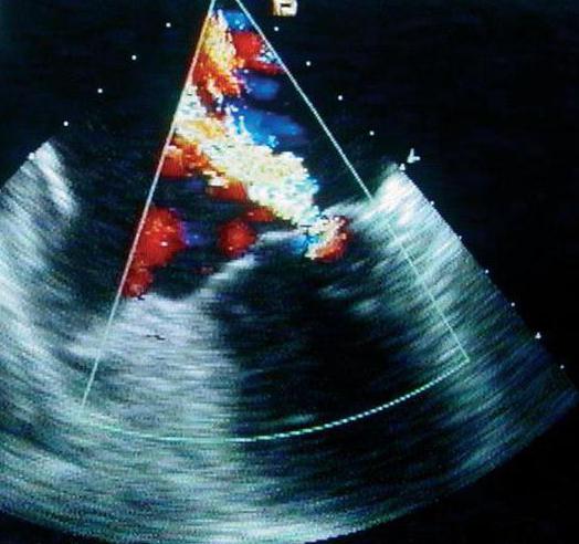 transesophageal echocardiography of the heart performing