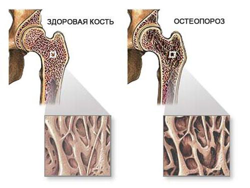 diffuse Osteoporose Knochen