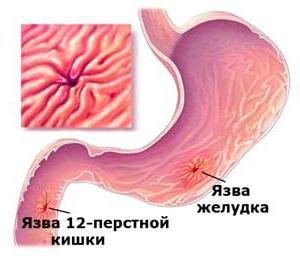 hastalık 12 duodenal ülser