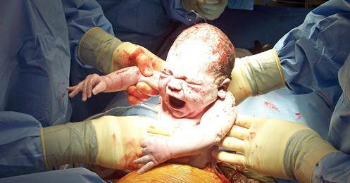 a história de um parto por cesariana