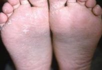 皮疹在脚在一个儿童诊断、治疗、预防