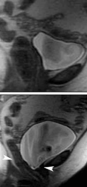 what shows MRI of the pelvis in women with infertility