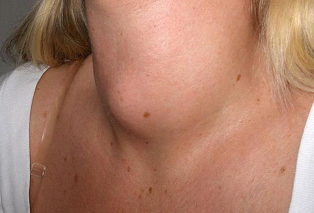 Nodos de la tiroides que son peligrosos dimensiones