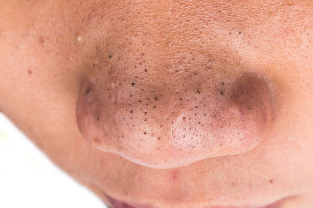 ¿ayuda циндол de acné en el rostro