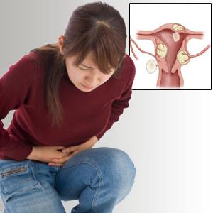 fibroids symptoms