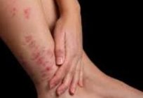 Psoriasis: causes, symptoms and treatment