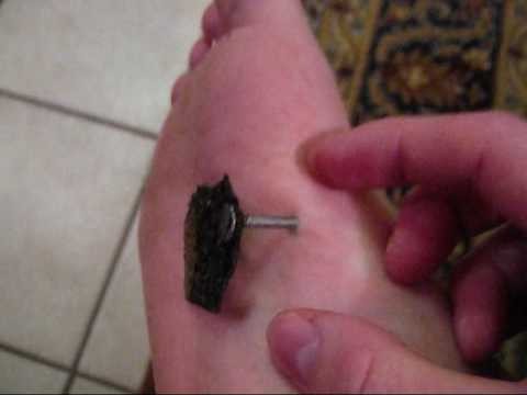 pierced a foot a nail what to do