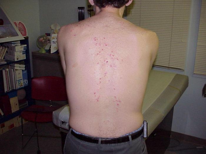 जिगर की बीमारी के लक्षण त्वचा पर एक तस्वीर
