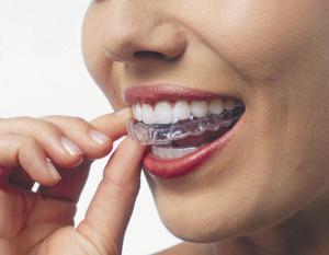 كم هو تبييض الأسنان عند طبيب الأسنان أو في المنزل