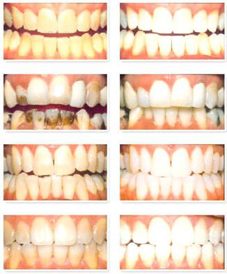 Відбілювання зубів в стоматології: ціни, відгуки