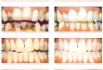 有多少是美白牙齿在牙科。 特的美白牙齿在现代牙科