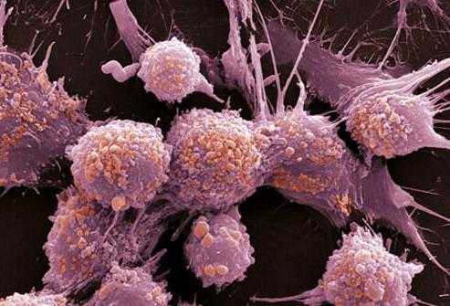 腫瘍性過程では、がんは