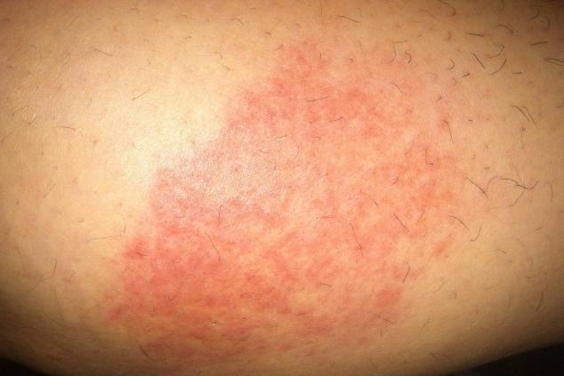 Roter Fleck auf der Haut Beine.