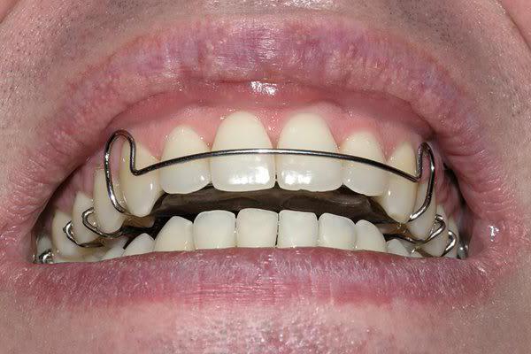 plate to align the teeth in children
