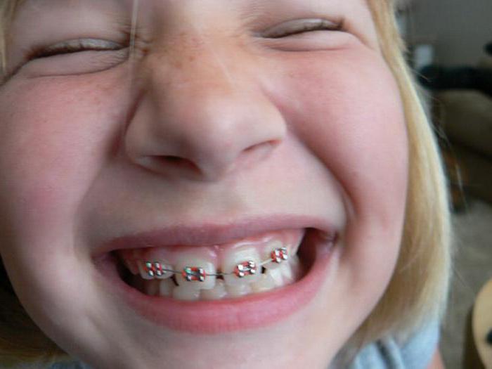 placas para o alinhamento dos dentes em crianças foto