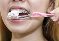 Placa para la alineación de los dientes: los clientes de los dentistas y los pacientes
