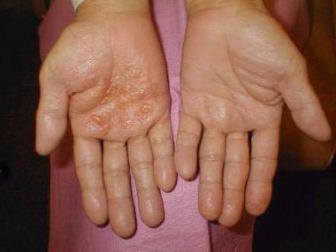 a crônica, eczema mãos de tratamento