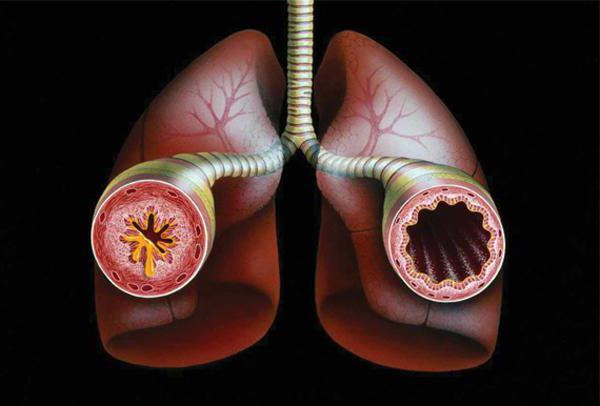 el asma causa