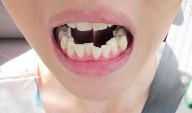 скупченість зубів