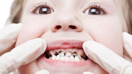 überbelegung der Zähne des Unterkiefers