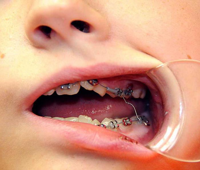 Gedränge Zähne Behandlung
