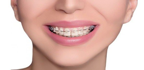 Gedränge Zähne Zahnspange