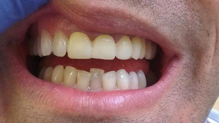 la revisión amontonamiento de los dientes