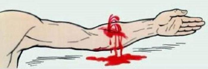 first aid for the capillary venous arterial bleeding