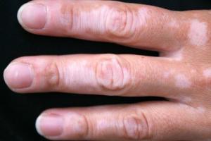 las manchas blancas en la piel de las manos