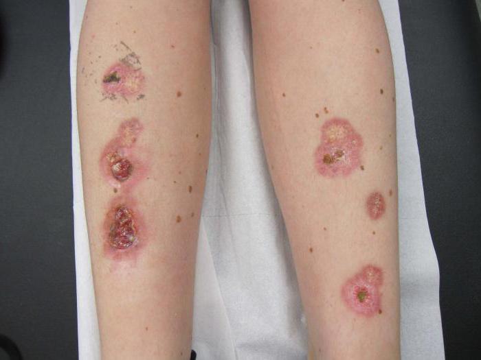 Lipoid necrobiosis: okok, tünetek, diagnózis és kezelés